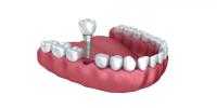Implantologia dentale Sforzacosta di Macerata